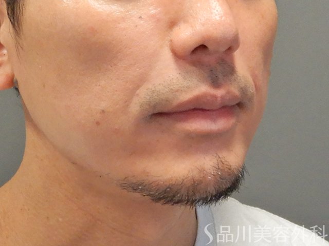 症例NO.73372のAFTER写真