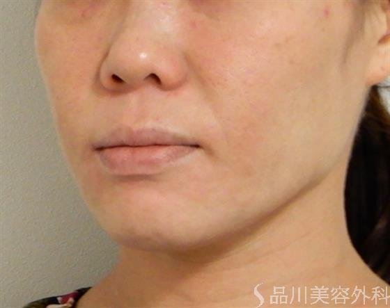 症例NO.38562のBEFORE写真