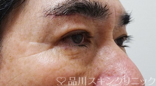 症例NO.69799のAFTER写真