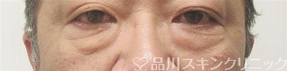 症例NO.58101のBEFORE写真