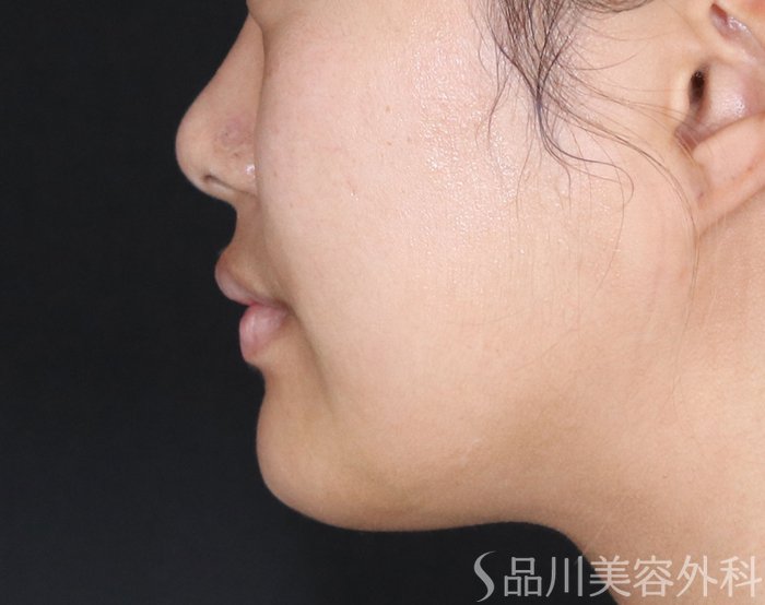 症例NO.72333のAFTER写真