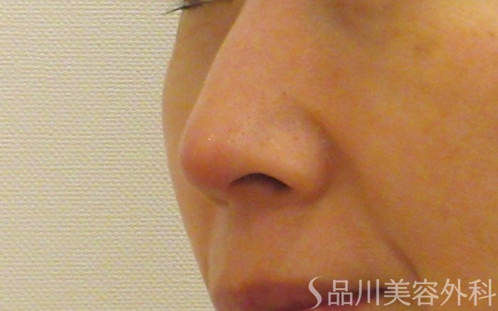 症例NO.69353のAFTER写真