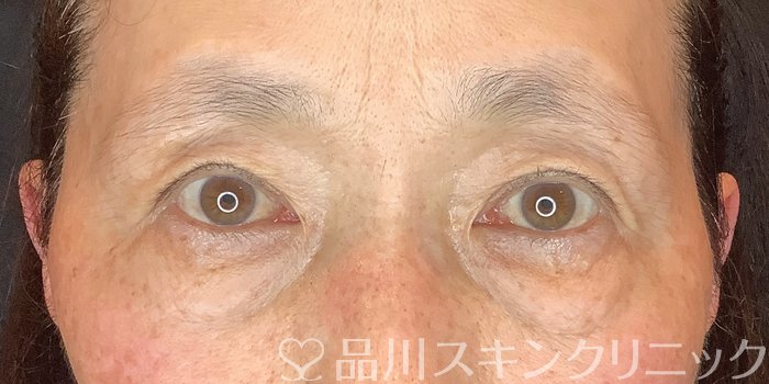 症例NO.71843のBEFORE写真