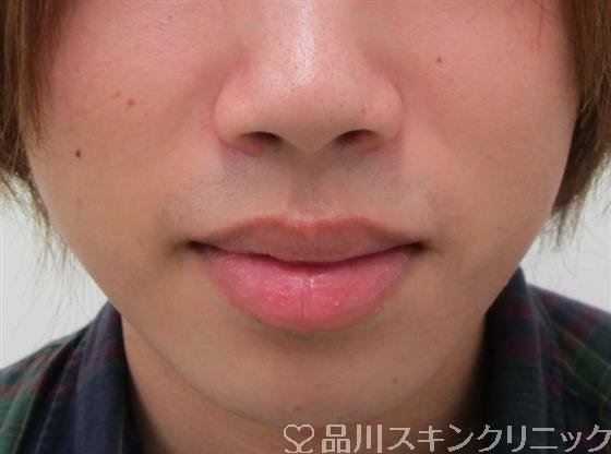 症例NO.30735のBEFORE写真