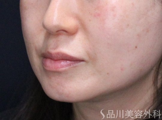 症例NO.73034のAFTER写真