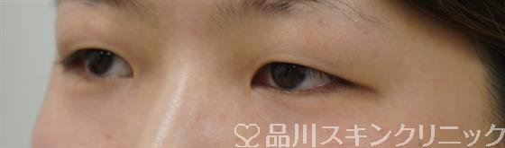 症例NO.39549のAFTER写真