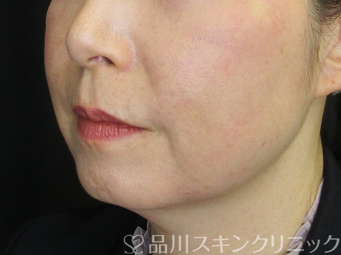 症例NO.73156のAFTER写真