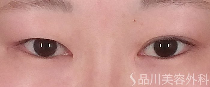 症例NO.69201のBEFORE写真