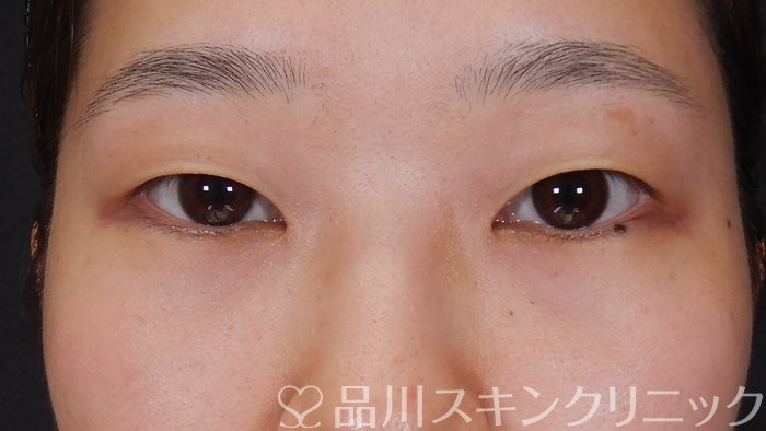 症例NO.62820のBEFORE写真