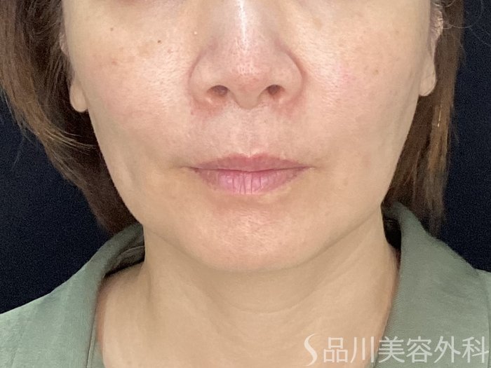 症例NO.71886のBEFORE写真