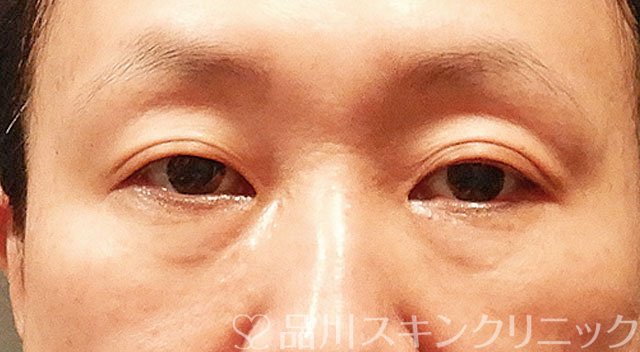 症例NO.62996のBEFORE写真