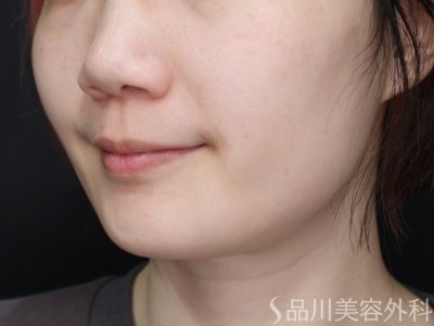 症例NO.73702のAFTER写真