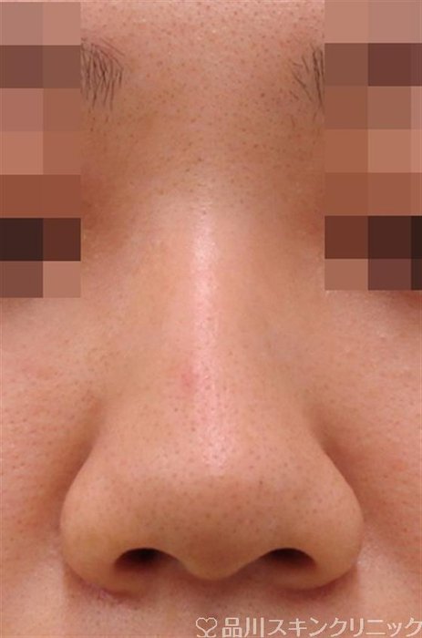 症例NO.38026のBEFORE写真