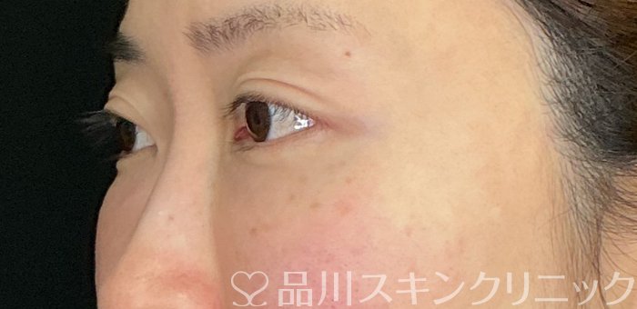 症例NO.74914のAFTER写真