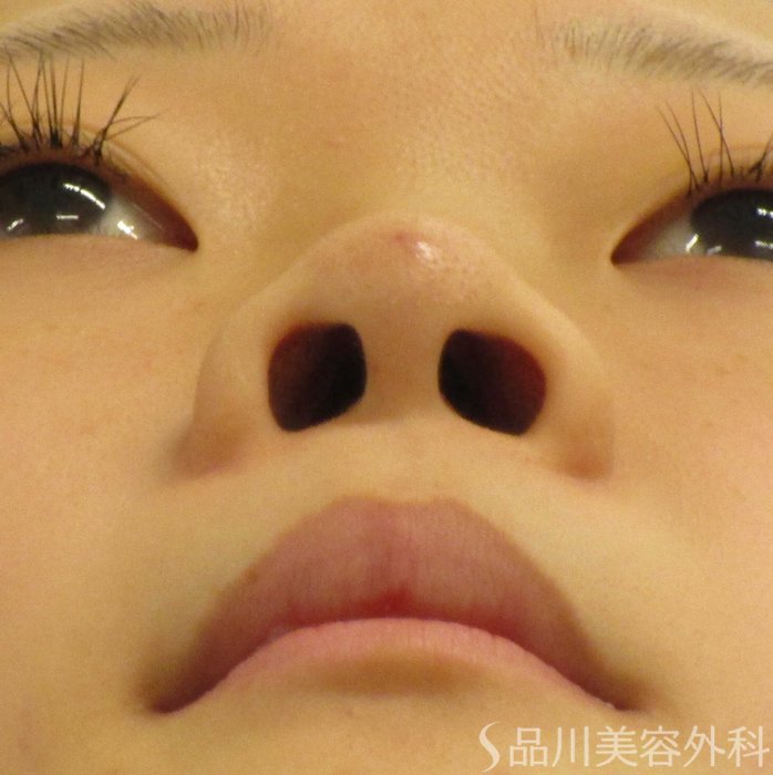 症例NO.62383のBEFORE写真