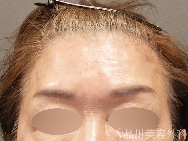 症例NO.72717のAFTER写真