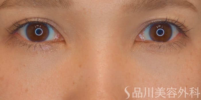 症例NO.65084のAFTER写真
