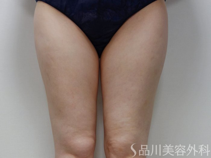 症例NO.73374のBEFORE写真