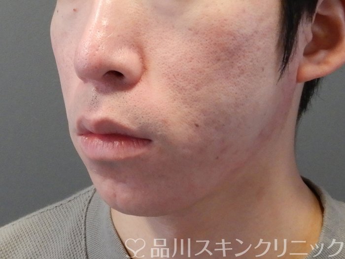 症例NO.70426のAFTER写真