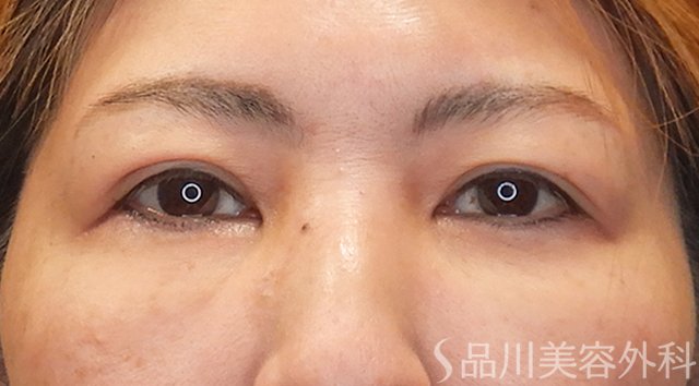 症例NO.75297のAFTER写真