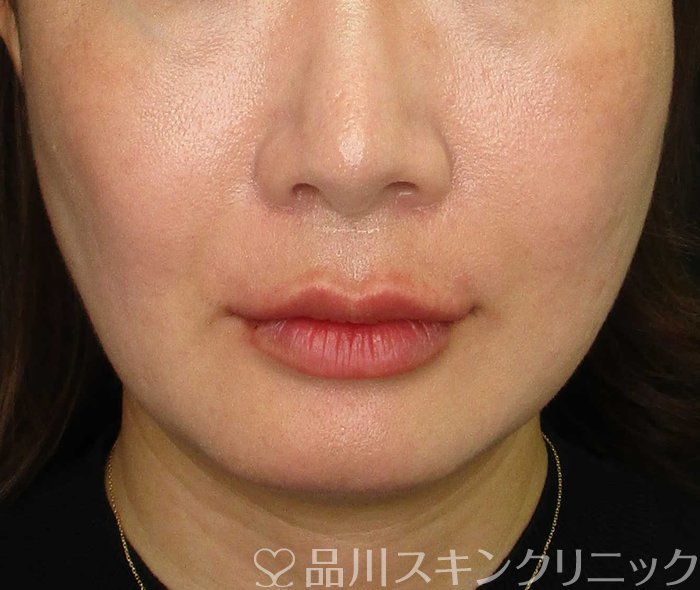 症例NO.67941のAFTER写真