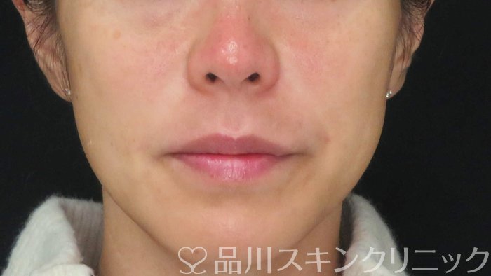 症例NO.71223のAFTER写真