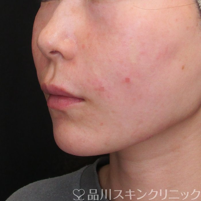 症例NO.73274のAFTER写真