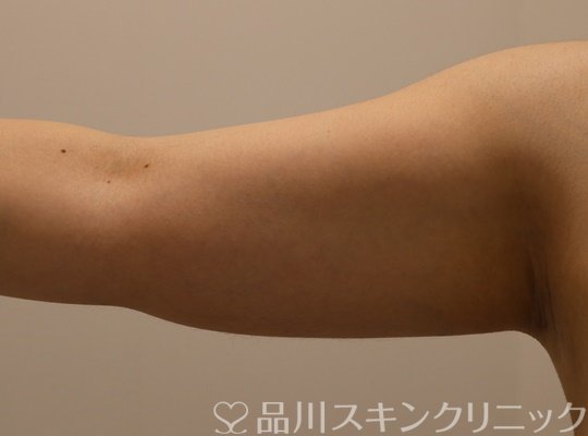 症例NO.70474のBEFORE写真