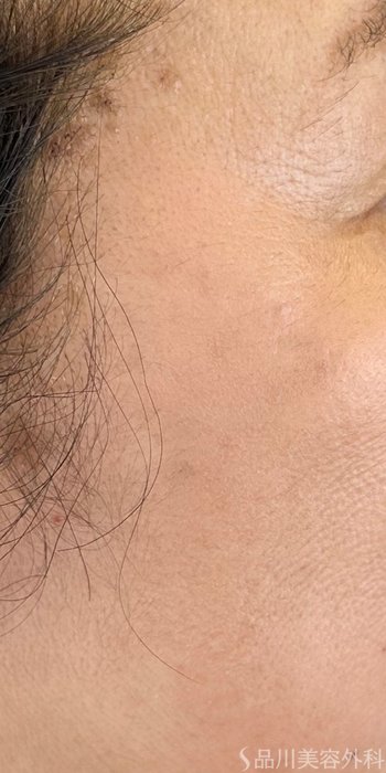 症例NO.72553のAFTER写真