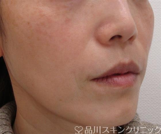 症例NO.41445のAFTER写真