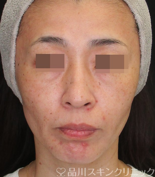 症例NO.75236のBEFORE写真