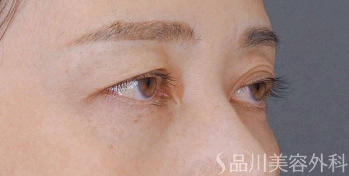 症例NO.74891のBEFORE写真