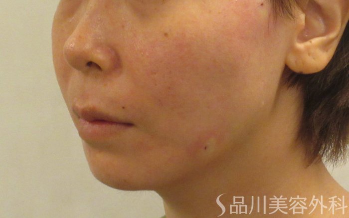 症例NO.71495のAFTER写真