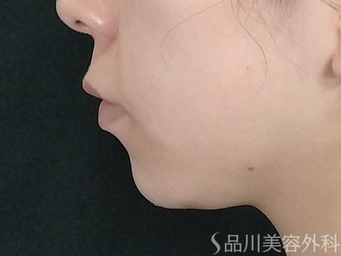 症例NO.70616のBEFORE写真