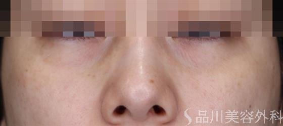 症例NO.61680のBEFORE写真