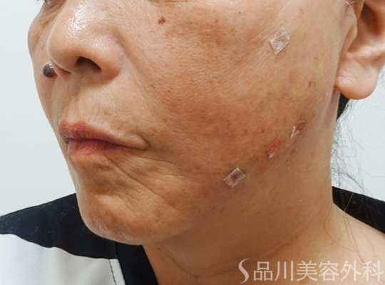 症例NO.73210のAFTER写真