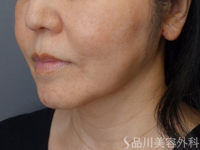 症例NO.72942のBEFORE写真