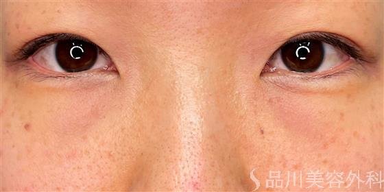 症例NO.61267のBEFORE写真