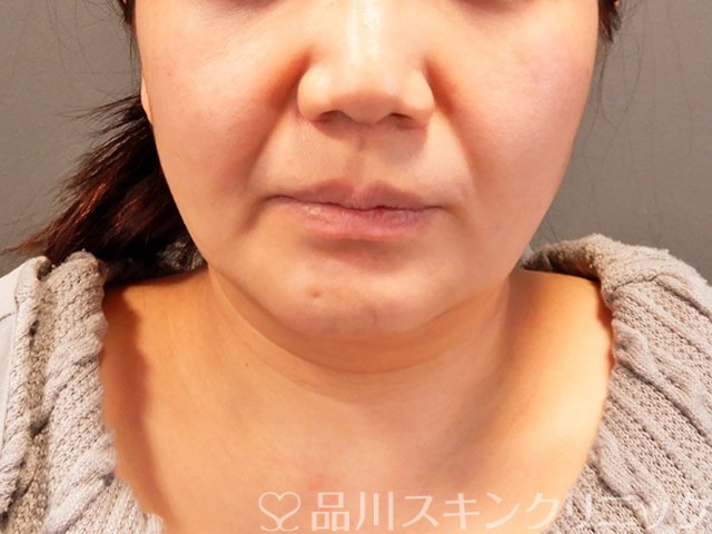 症例NO.69394のAFTER写真