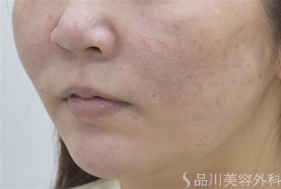 症例NO.46122のAFTER写真