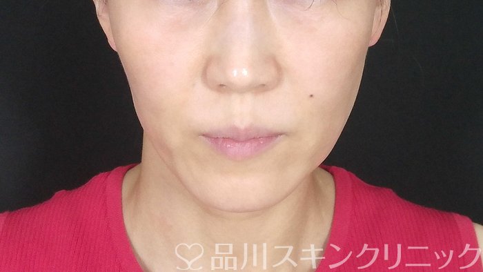 症例NO.72273のBEFORE写真