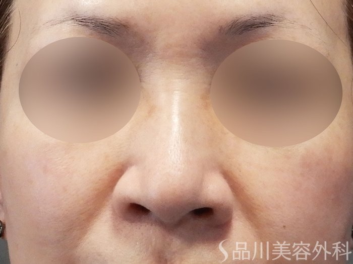 症例NO.70618のBEFORE写真