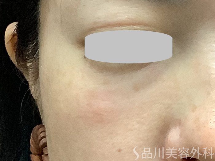 症例NO.67846のAFTER写真