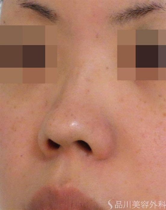 症例NO.40101のBEFORE写真