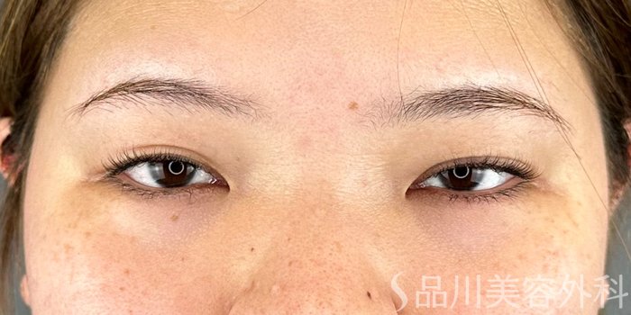 症例NO.70782のBEFORE写真