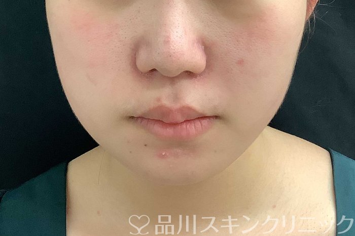 症例NO.69778のAFTER写真