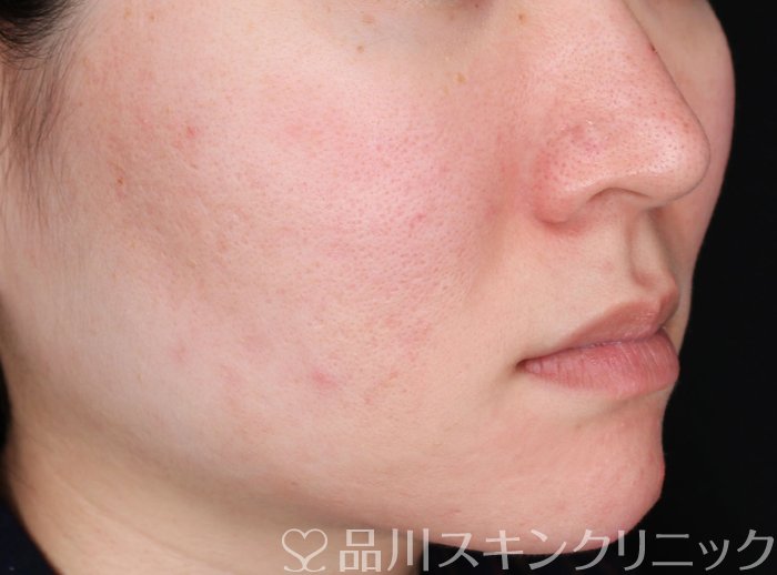 症例NO.64552のBEFORE写真