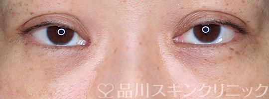 症例NO.65057のAFTER写真