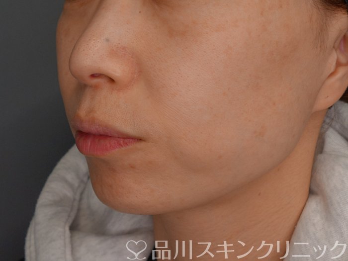 症例NO.74439のBEFORE写真