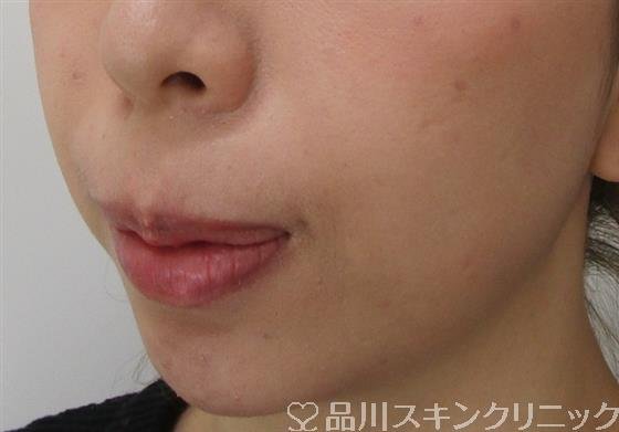 症例NO.39635のAFTER写真